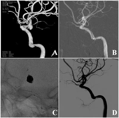 Effects of stent-assisted coiling in comparison with flow diversion on intracranial aneurysms